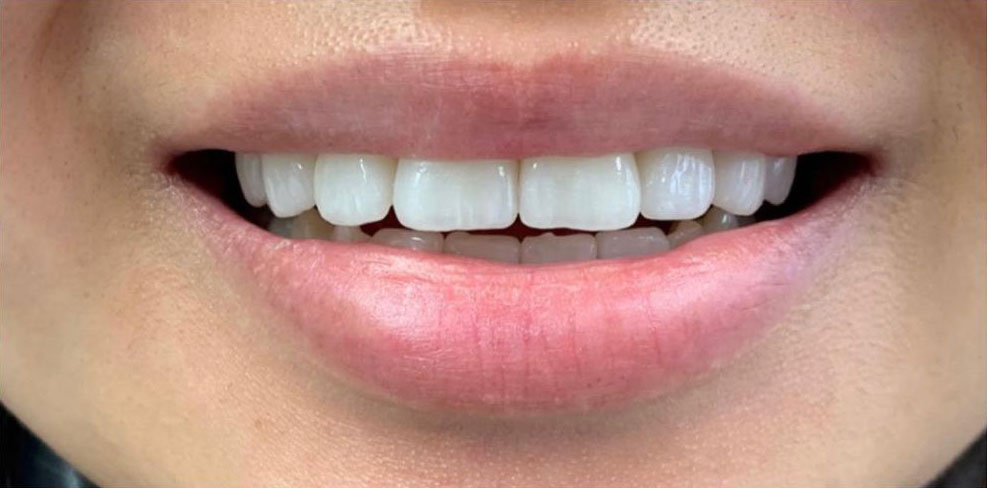 Zähne nach der Behandlung gerade weiß