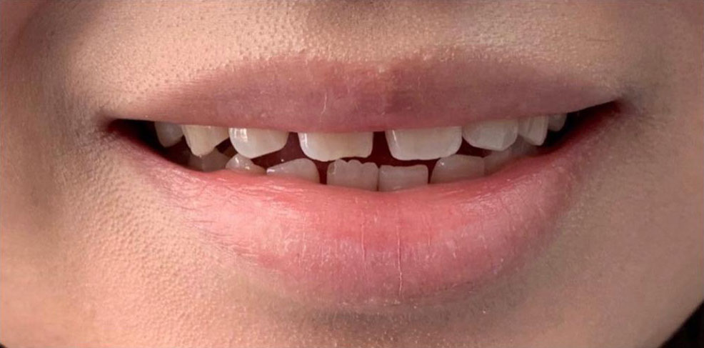 Mund Zähne vor der Behandlung schief