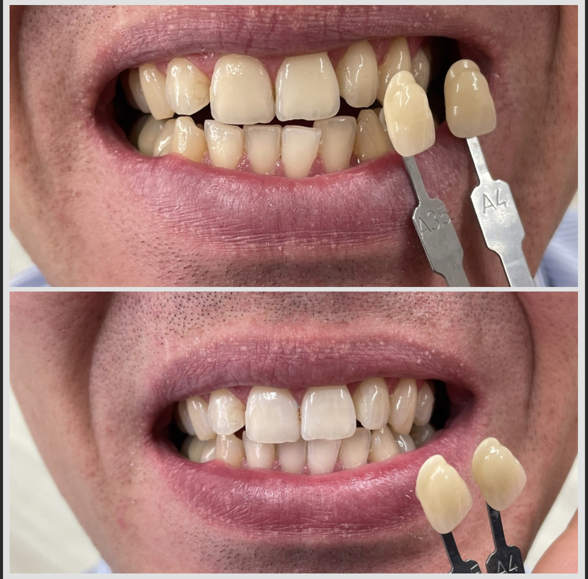 Zahnverfärbungen – Ursachen & Behandlung